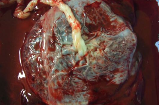 Ljudska placenta