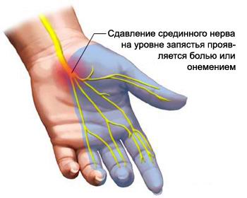 bolovi u zglobovima nakon moždanog udara)
