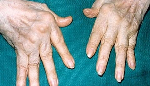 uzrokujući bol u zglobovima prstiju