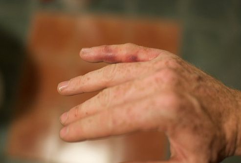 Artritis u prstima ruku liječenja