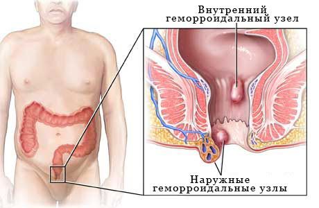 Prevalencija hemoroida