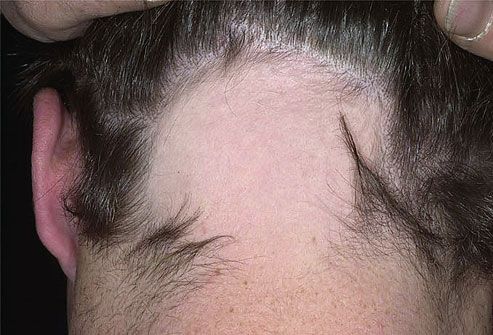 Alopecija areata