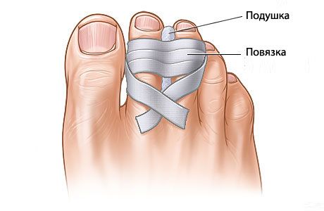 artroza liječenje velikog nožnog prsta)