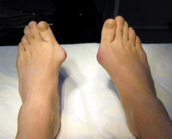 liječenje artroze na velikom nožnom prstu)