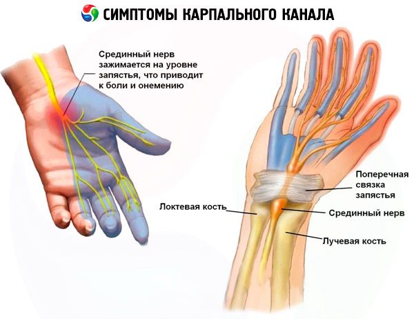 Sindrom karpalnog kanala ili tunela - bol prstiju i šake