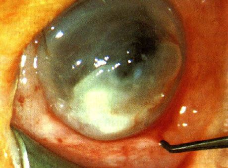 Keratitis uzrokovan Pseudomonas u novorođenčadi.  Predisponirajući čimbenici nisu identificirani