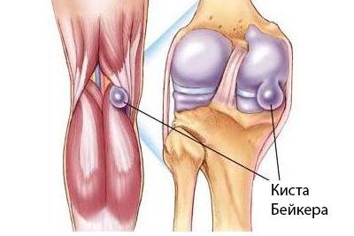 bol u zglobu koljena bakerne ciste)