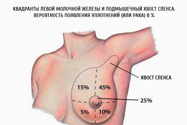 Kvadranti lijeve dojke i axillary spence od spence.  Vjerojatnost pečata (ili raka) u%