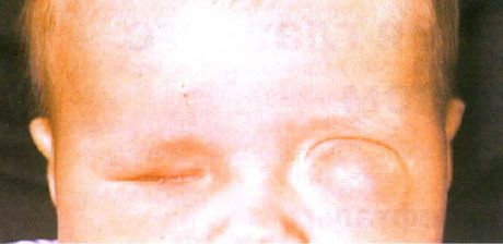 Microphthalmus s istodobnom formiranjem ciste (lijevom oku).  Anophthalmus (desno oko).