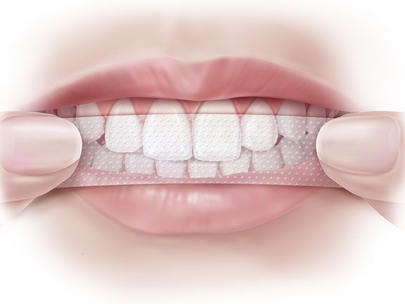 Kako koristiti izbjeljivanje traka za zube?
