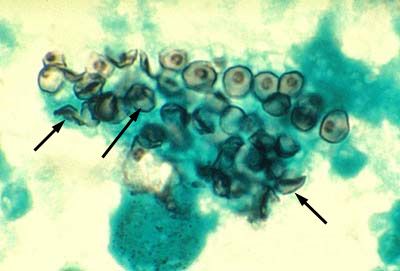 Uzročnik pneumokokisa (Pneumocystis jiroveci)