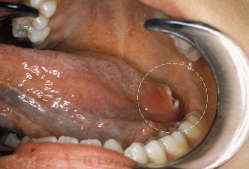 Oralni karcinom