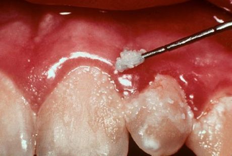 Zubi i gingivitis