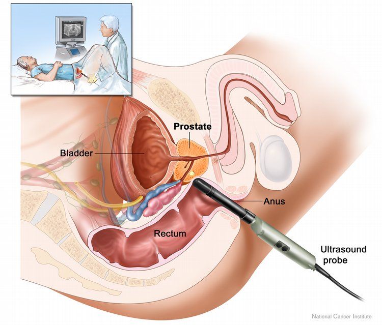 Stvoren je učinkovit lijek protiv raka prostate koji se temelji na čaju i zlatu