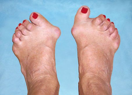 bol u malim zglobovima liječenja stopala
