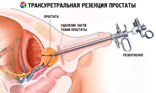 Operacija prostate i seks