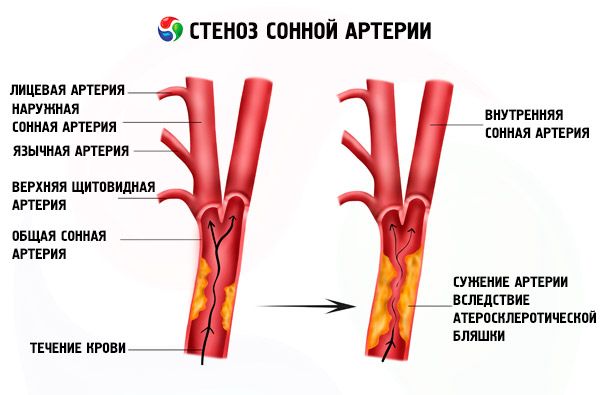 Arterijska stenoza i hipertenzija ,skleroza cerebralnih žila s hipertenzijom