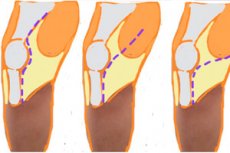 naselja liječenje artroze bol u kuku lijevo