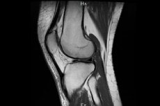 bol na stranama zgloba koljena liječenje artroze zobenom kašom