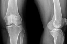 Liječenje artroze koljena