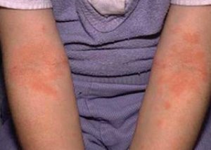 alergijski zglobovima)