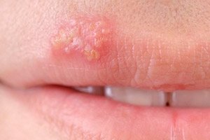 Herpes na usnama i oralni seks