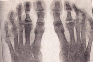 bol u kuku otrcao prste liječenje artroze koljena aloe