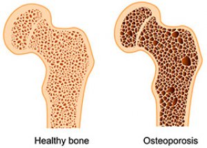 za bol kod osteoporoze u zglobu kuka artroza 2 stupnja liječenja koljena