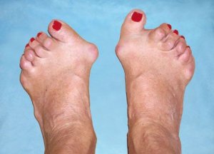 Bol u stopalu: Provjerite 4 glavna uzroka ovog problema i kako ga liječiti