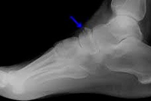 Što je artroza stopala - simptomi i liječenje, uzroci, kako liječiti bolest stopala - Kifoze - 