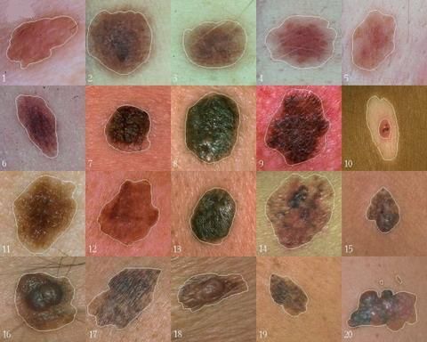 Znanstvenici su pronašli gen koji igra središnju ulogu u razvoju melanoma